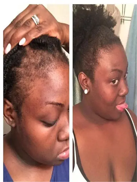 Resultado de recuperação da linha frontal do cabelo